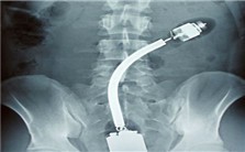 异物进入体腔现场急救视频教程 费国忠 3讲 上海市医疗急救中心
