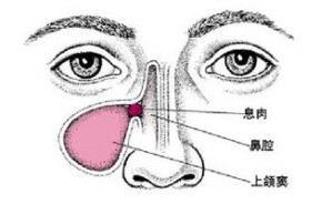 鼻腔炎症性疾病视频教程 周兵 2讲 北京同仁医院